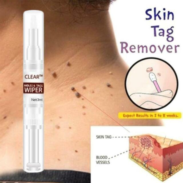 WipeOff Tags & Moles Remover